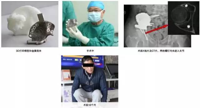 3d打印在醫(yī)療領域的應用 3D打印與醫(yī)療行業(yè)白皮書