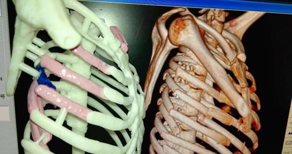 3D打印技術在醫療領域的應用