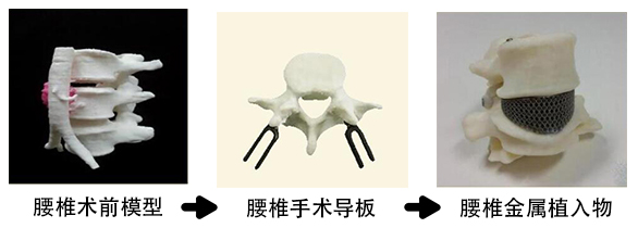 腰椎金屬植入物2